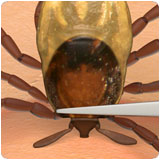 image showing tick removal with pointy tweezers